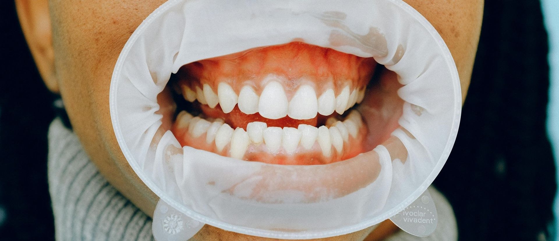 Patient getting a gum examination in Seattle, Washington