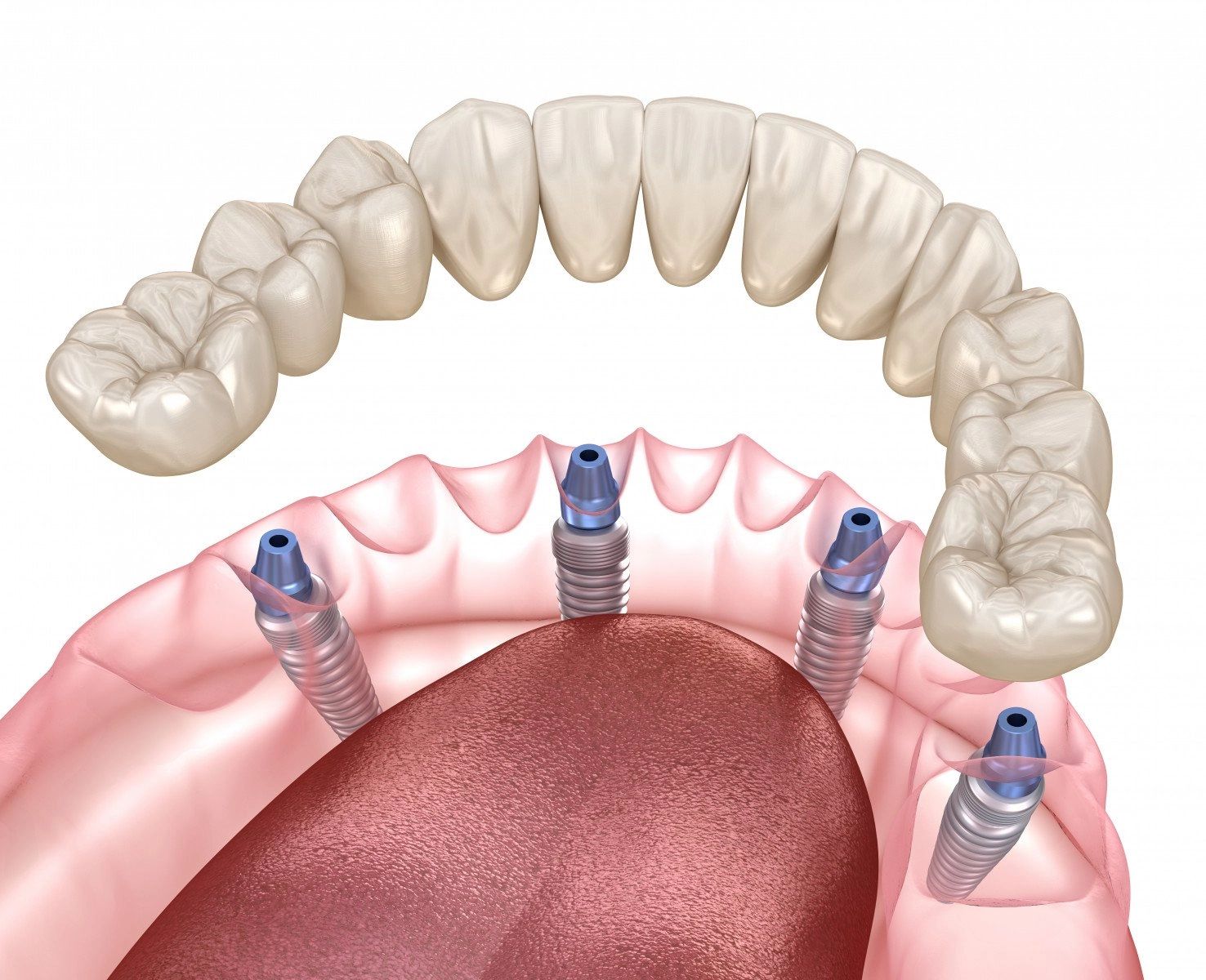 Seattle Area All on 4 dental implants