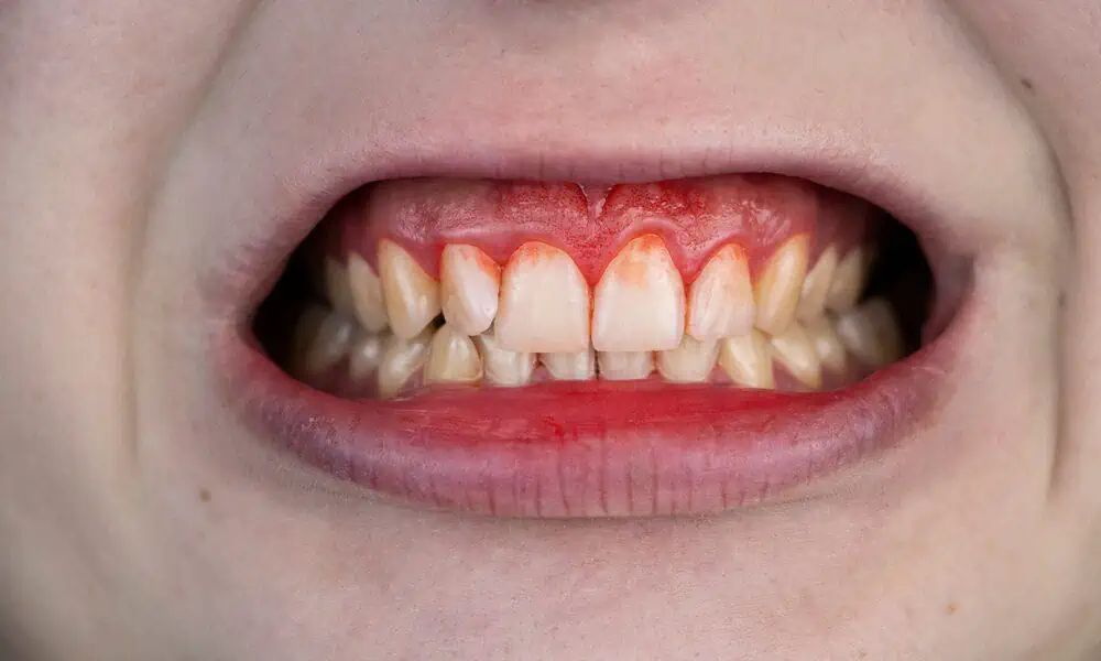 Bleeding gums 