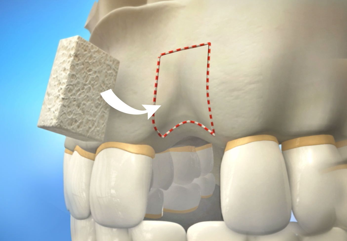 Zoom whitening at Aurora Dental Care in Seattle, Washington