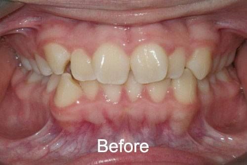 Patient Before Braces at Aurora Dental Care