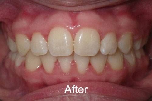 Patient After Braces from Aurora Dental Care