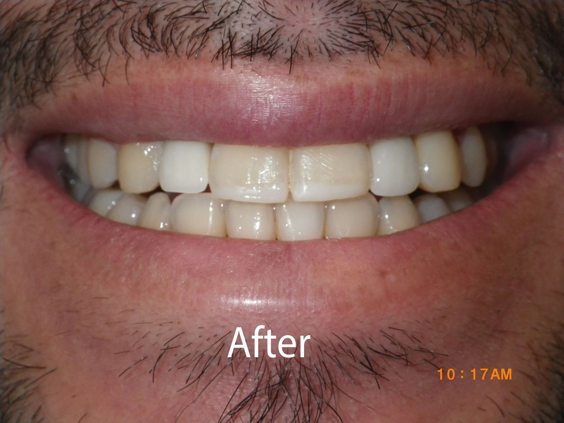 Patient After Braces from Aurora Dental Care