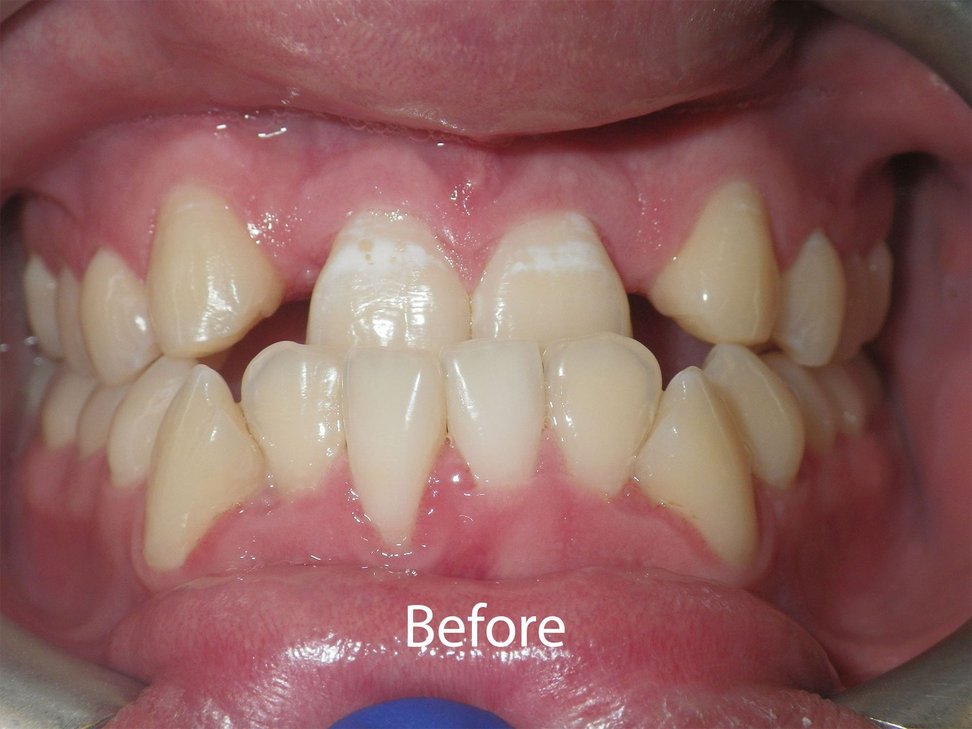 Patient Before Braces at Aurora Dental Care