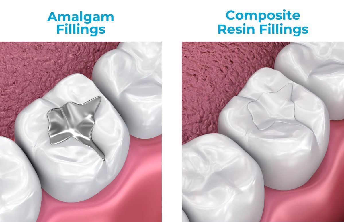 Seattle Area Composite fillings