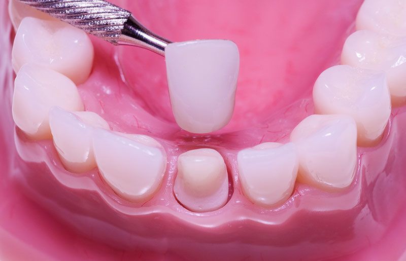 Seattle Area Dental Crowns