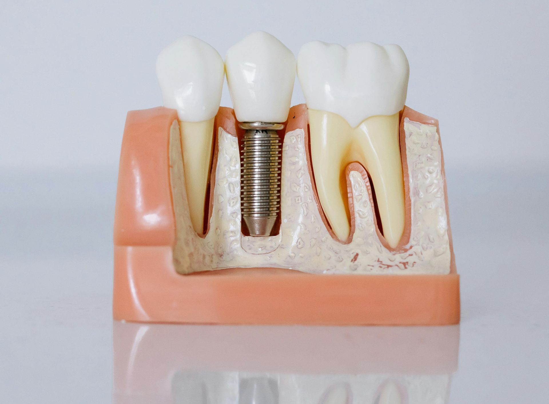 Dental implants are better for gum health than dentures