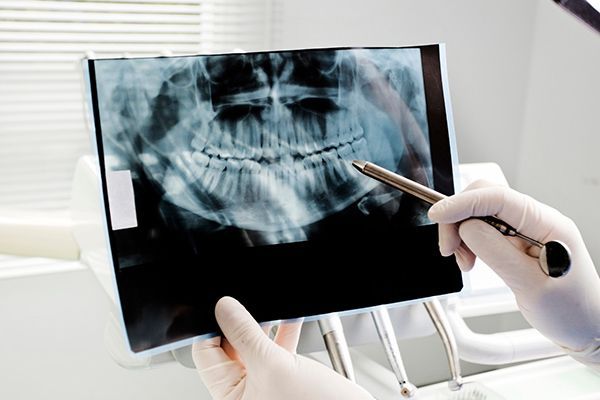 Dental Crown Procedure