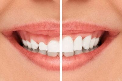 Cosmetic Dentistry in Seattle