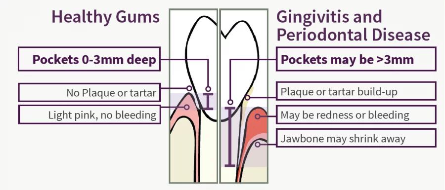 Healthy Gums vs Periodontal Disease