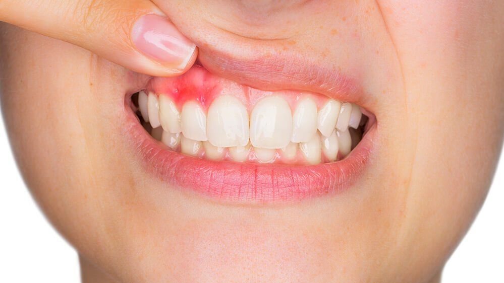 patient with slightly inflamed gums