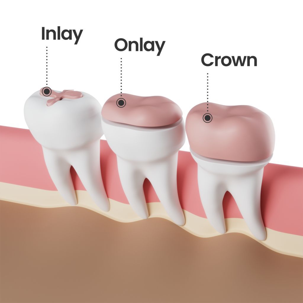 Inlays vs Onlays