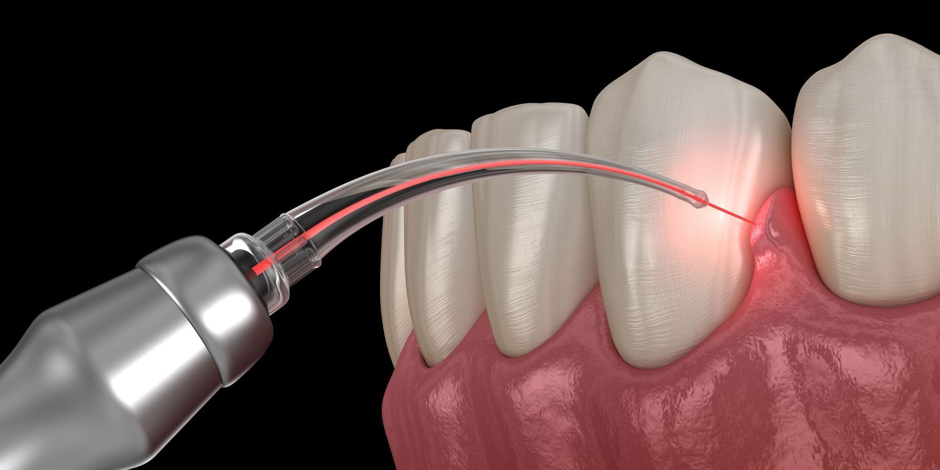 A dental laser tool emits a red light beam onto the gum line between two human teeth for a periodontal treatment.