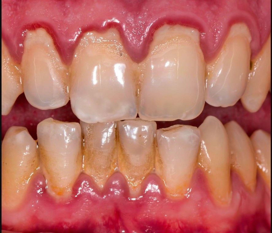 patient with receding gums
