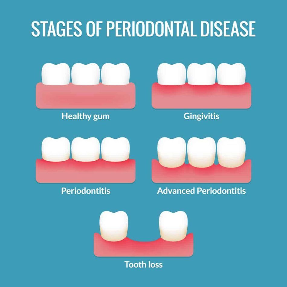 Periodontal Disease Cahrt