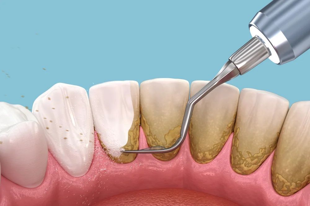 diagram of periodontal maintenance