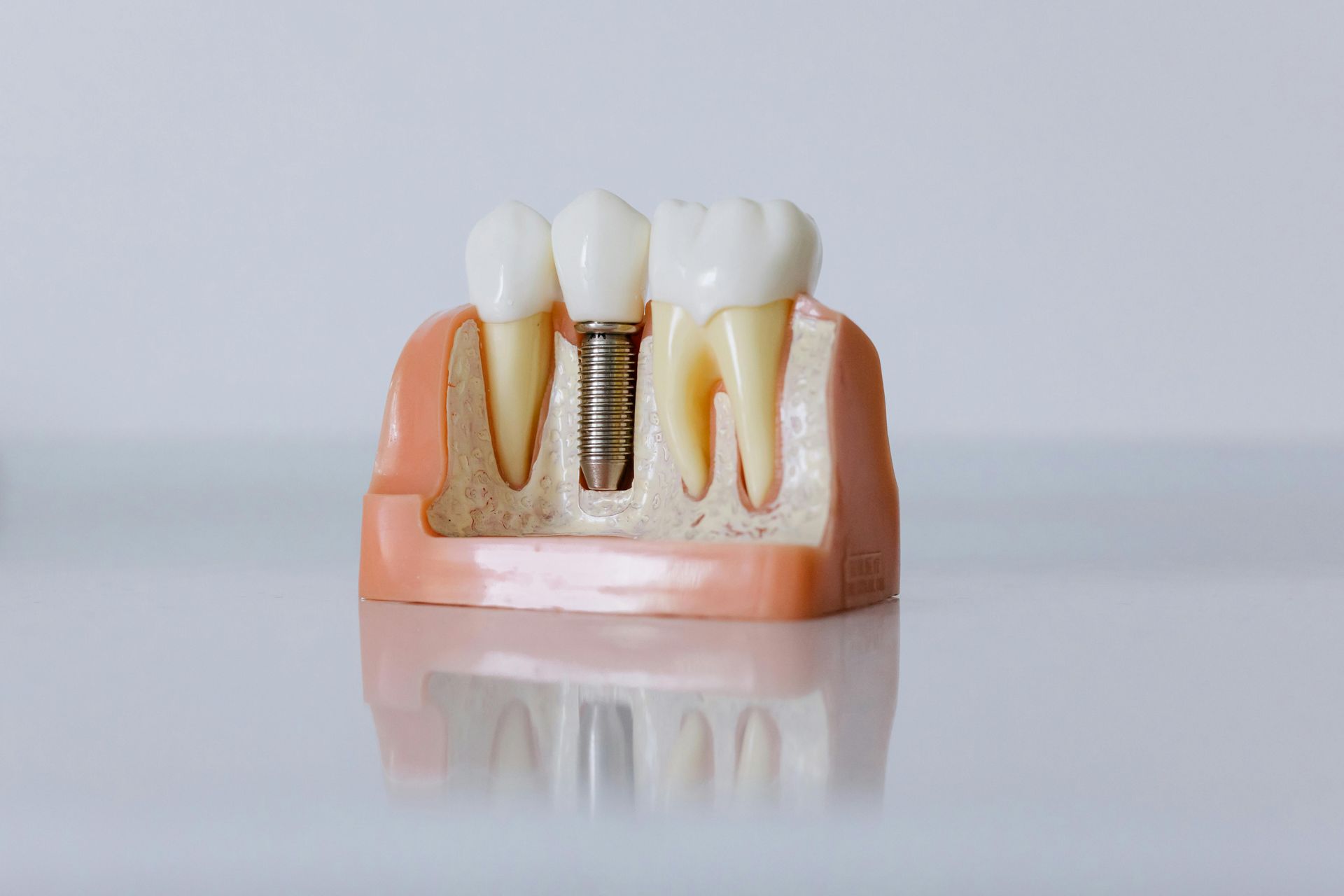 Dental implant model with two teeth and pink gum base on a reflective surface