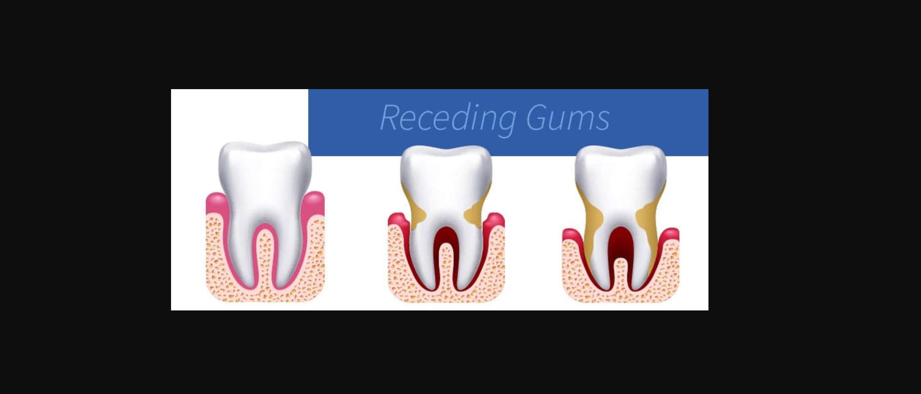 Receding Gums in Seattle, WA