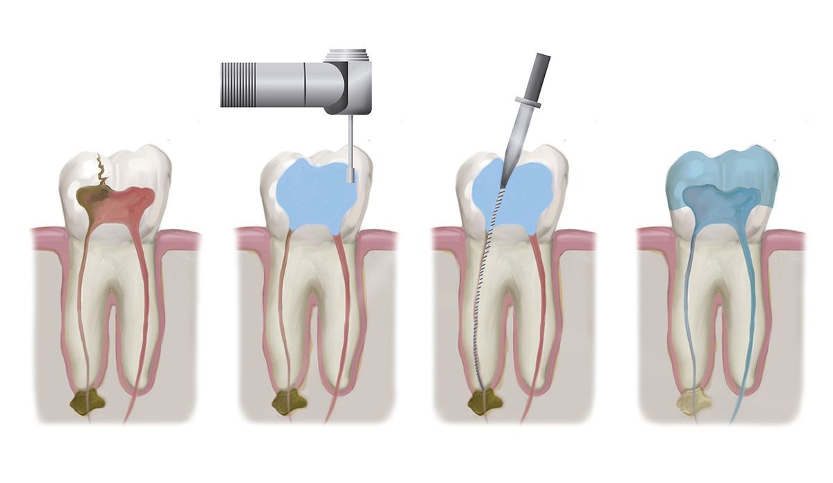 Root canal therapy in Seattle