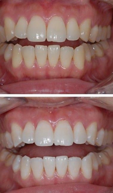 Teeth whitening before and after