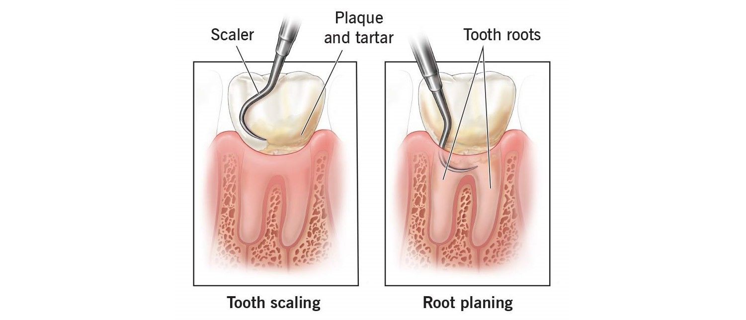 Diagram of Tooth Scaling and Root Planing