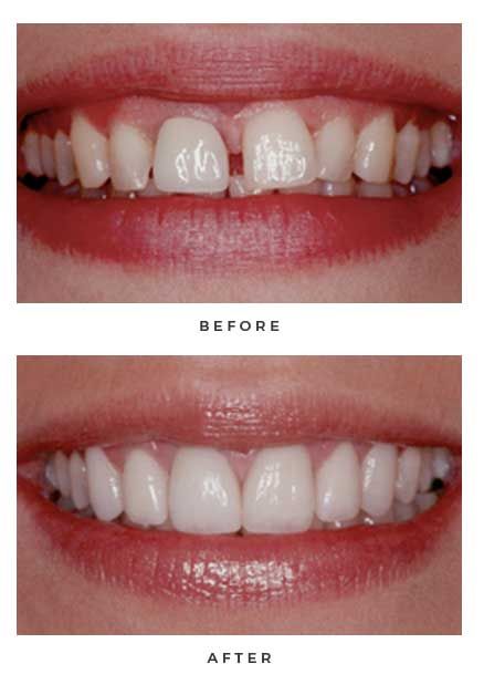 Veneers before and after