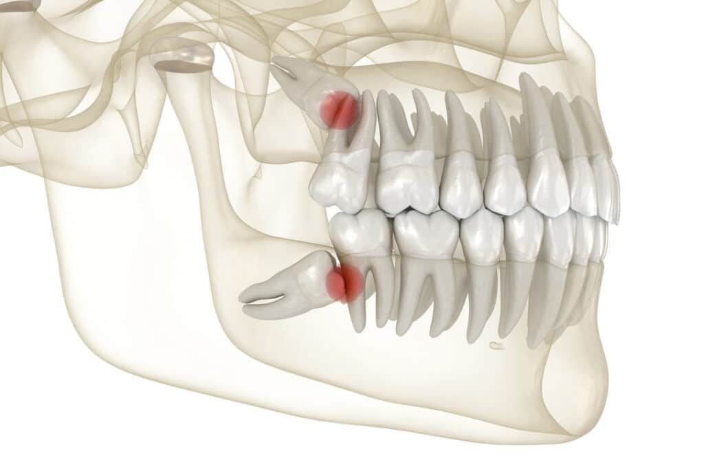 impacted wisdom teeth