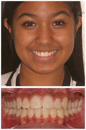 Woman with a wide smile showing her teeth, and a close-up view of her aligned teeth.