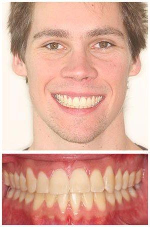 Smiling man with close-up view of teeth. He has light skin and brown hair, his teeth are straight and light-yellow.