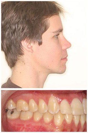 Profile view of a man's face and a close-up of his upper teeth, revealing slight crowding.