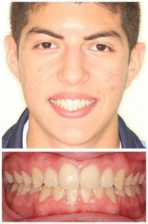 Young man smiling, showing teeth in front view. Lower view shows his teeth.