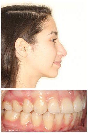 Woman's profile and teeth: a side view shows a straight nose and a close-up of misaligned teeth.