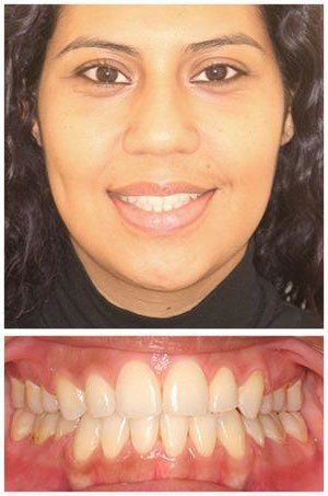 Woman smiling, showing teeth. Close-up of face above mouth with teeth.  Light skin, black shirt.