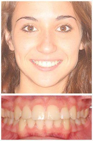 Smiling woman with brown hair and teeth, showing her upper and lower teeth.