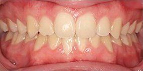 Close-up view of an open mouth showing teeth and gums. Teeth are yellowish, and gums are pink.