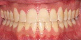 Close-up of a person's teeth, showing a full set of slightly yellowed, well-aligned teeth and pink gums.