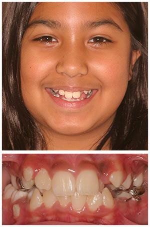 Smiling girl with crooked teeth; close-up of mouth shows orthodontic appliance.