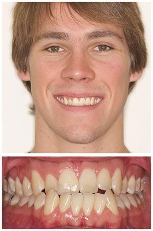 Smiling young man with slightly crooked teeth. Close-up of the teeth in the lower half.