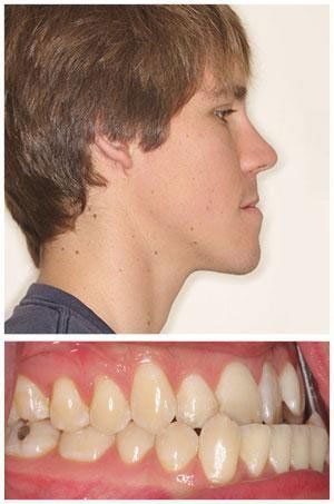 Side profile of a young man with a slightly recessed chin; below, close-up of his teeth with overbite.