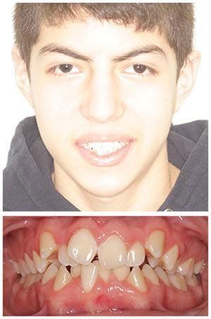 Young man's face and teeth. Upper image: smiling face. Lower image: teeth close-up showing crowding.