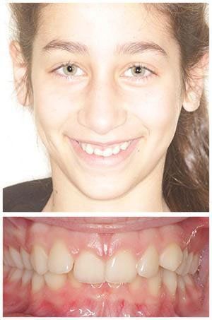 Smiling girl with teeth in need of orthodontic work. Close-up shows crooked teeth.