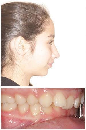 Profile and intraoral view of a young person, revealing a side face and dental malocclusion.