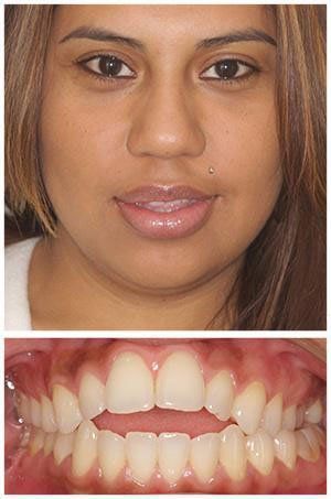 Woman with a healthy smile, upper and lower teeth visible; tan skin.