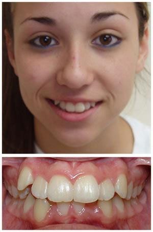 Woman with crooked teeth smiles, showing closeup of misaligned upper teeth.