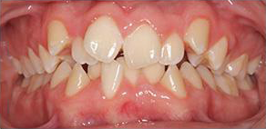 Mouth with severely misaligned teeth, crowded and overlapping. Pink gums, off-white teeth.
