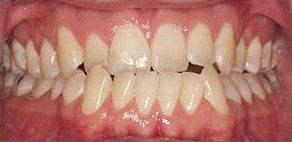 A close-up view of a mouth displaying teeth; the teeth are mostly white with some yellowing.