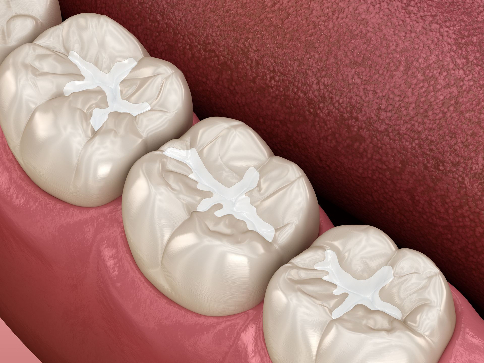 A close up of a row of teeth with fillings in them.