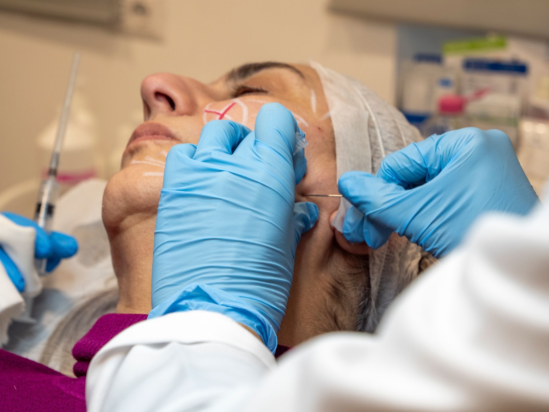 Una donna si sta sottoponendo a un'iniezione di botox sul viso.