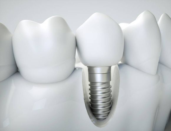 Impianto dentale in titanio e corone in metallo ceramica
