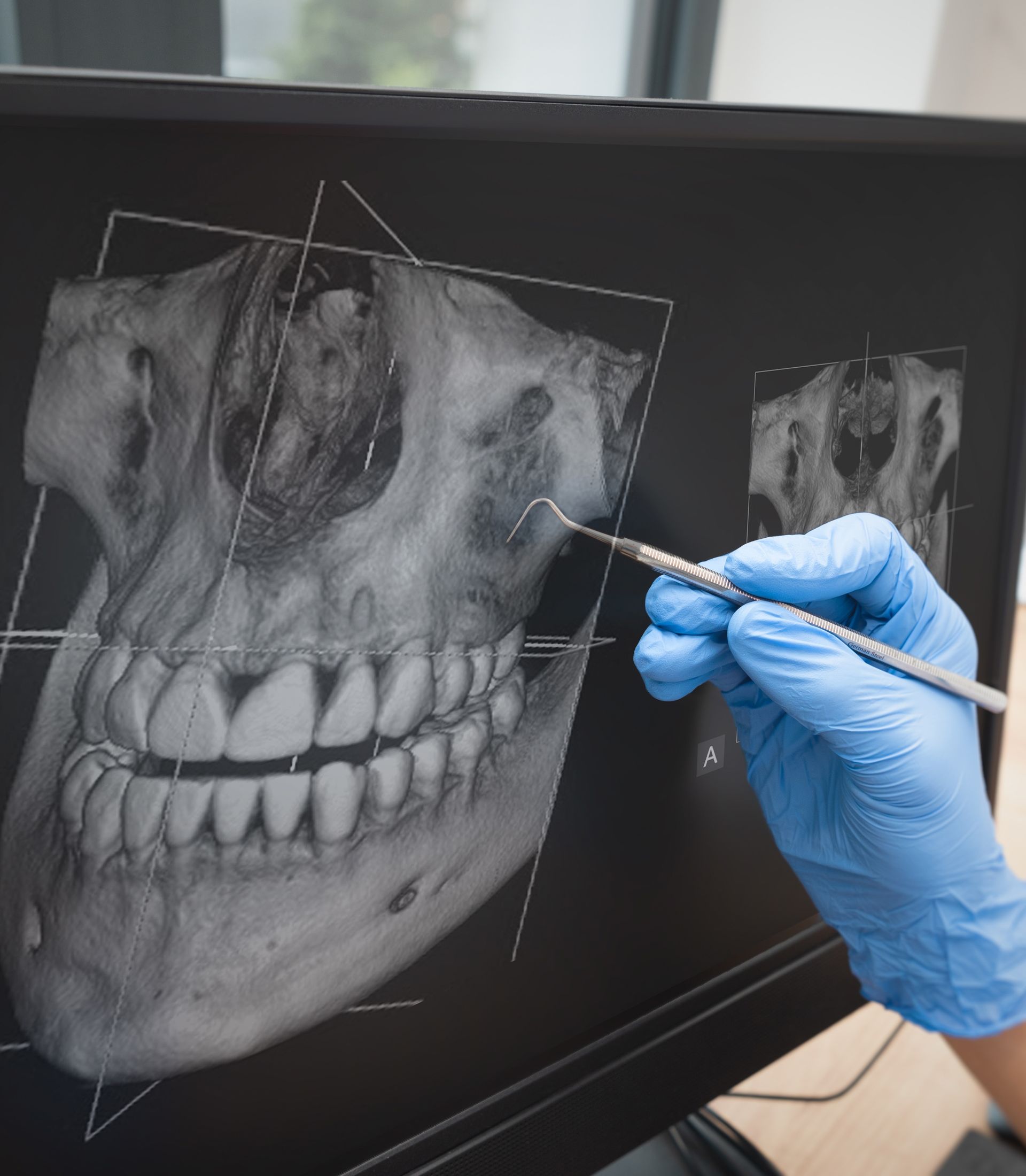 A person is holding a dental tool in front of a computer screen.